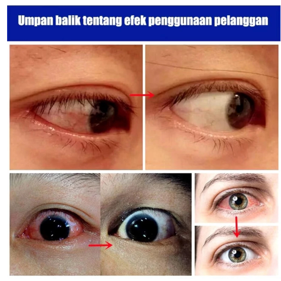 YEHUANGSU OBAT MATA TETES ORIGINAL MENGATASI MATA GATAL MATA MERAH MATA BERAIR MATA MINUS PENGLIHATAN BURAM 13ML - Gambar 4